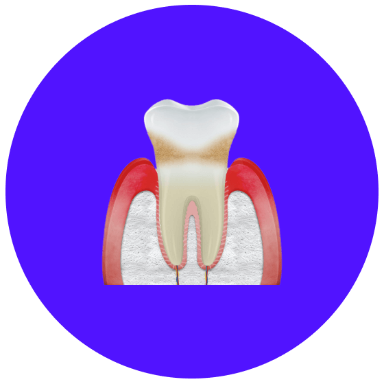 Zahnfleisch- oder Knochenverlust