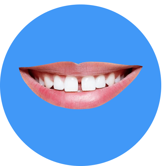 Zahnlücke_Diastema_Lächeln