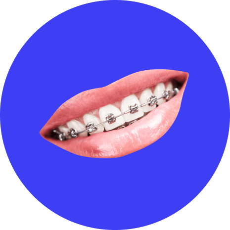 Metallische Zahnspange