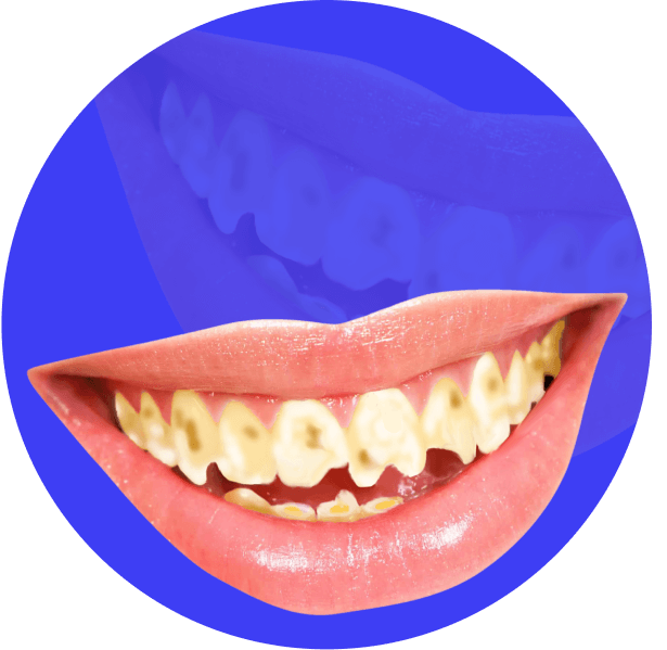 Verlust von Zahngewebe