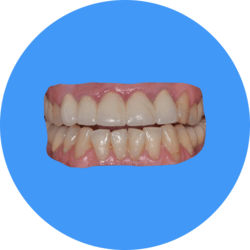 Weisses Zahnfleisch