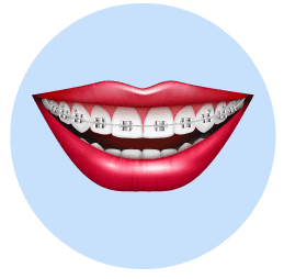 Zahnspangen-aus-Metall
